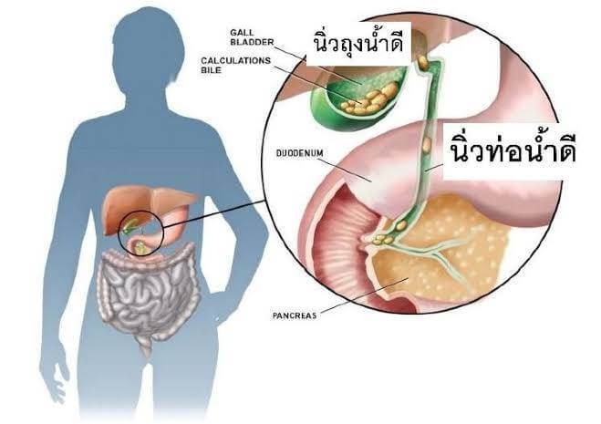 นิ่วถุงน้ำดี,รักษานิ่วในถุงน้ำดี,สลายนิ่วในถุงน้ำดี,ยาสลายนิ่ว,สมุนไพร,ธนทร,นิ่ว,นิ่วในไต,นิ่วในกระเพาะปัสสาวะ,รักษานิ่ว,ปัสสาวะขัด,ยาน้ำ,สมุนไพรธนทร